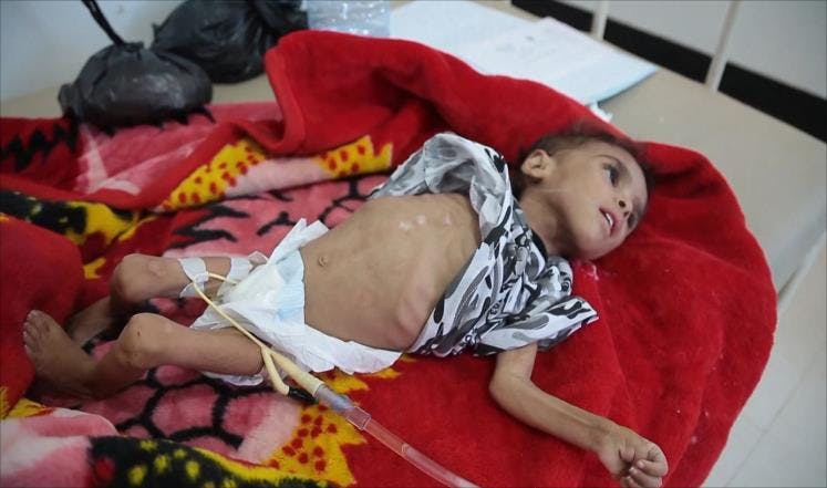 Cover Image for يونيسيف: كل عشر دقائق يموت طفل يمني من أمراض يمكن الوقاية منها